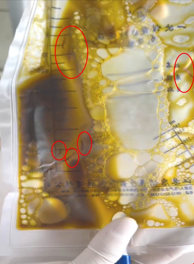 男子腹痛难忍，密密麻麻的虫子堵住了胆管！医生紧急提醒