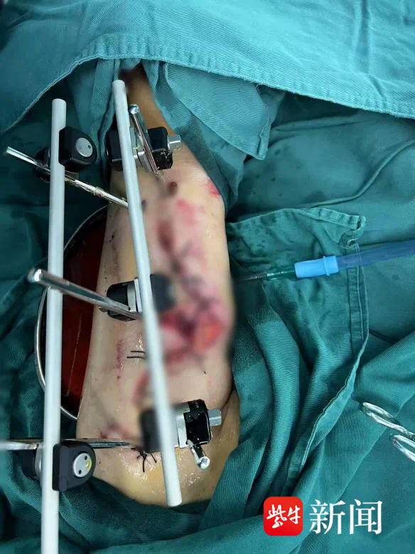 她用手语比出“谢谢”！六旬聋哑阿姨被割草机锯断手臂，医生紧急施救后转危为安