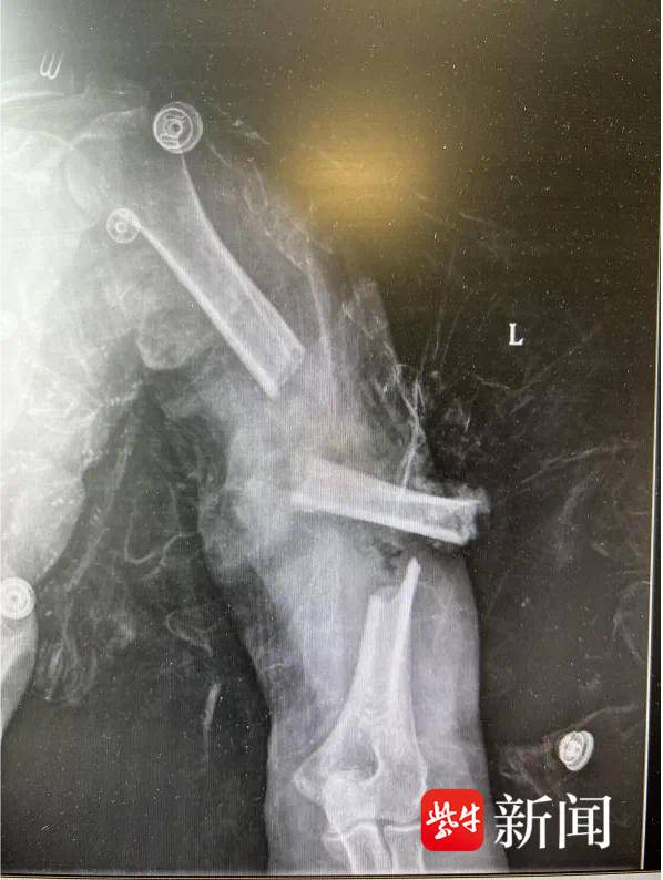 她用手语比出“谢谢”！六旬聋哑阿姨被割草机锯断手臂，医生紧急施救后转危为安