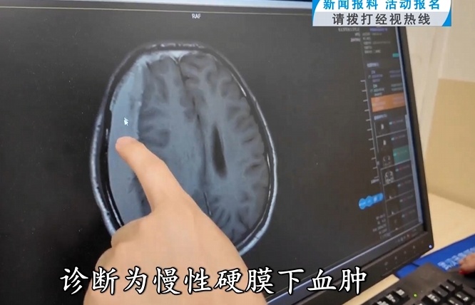 连坐两次过山车，37岁男子突发颅内出血！医生紧急提醒