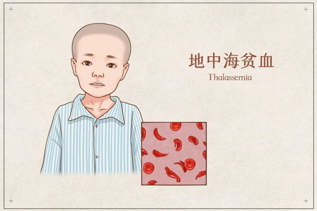 这个遗传病你了解多少？丨世界地中海贫血日