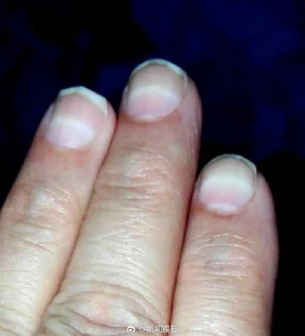 比砒霜还毒！湖南一3岁女童查出急性铊中毒，眼神呆滞、大把脱发、走路如踩棉花……