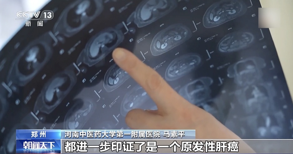 身体瘙痒竟查出肝癌？这些不起眼的症状可能是肝脏在“求救”