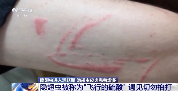 别拍打！“飞行硫酸”隐翅虫进入活跃期 防范指南请查收