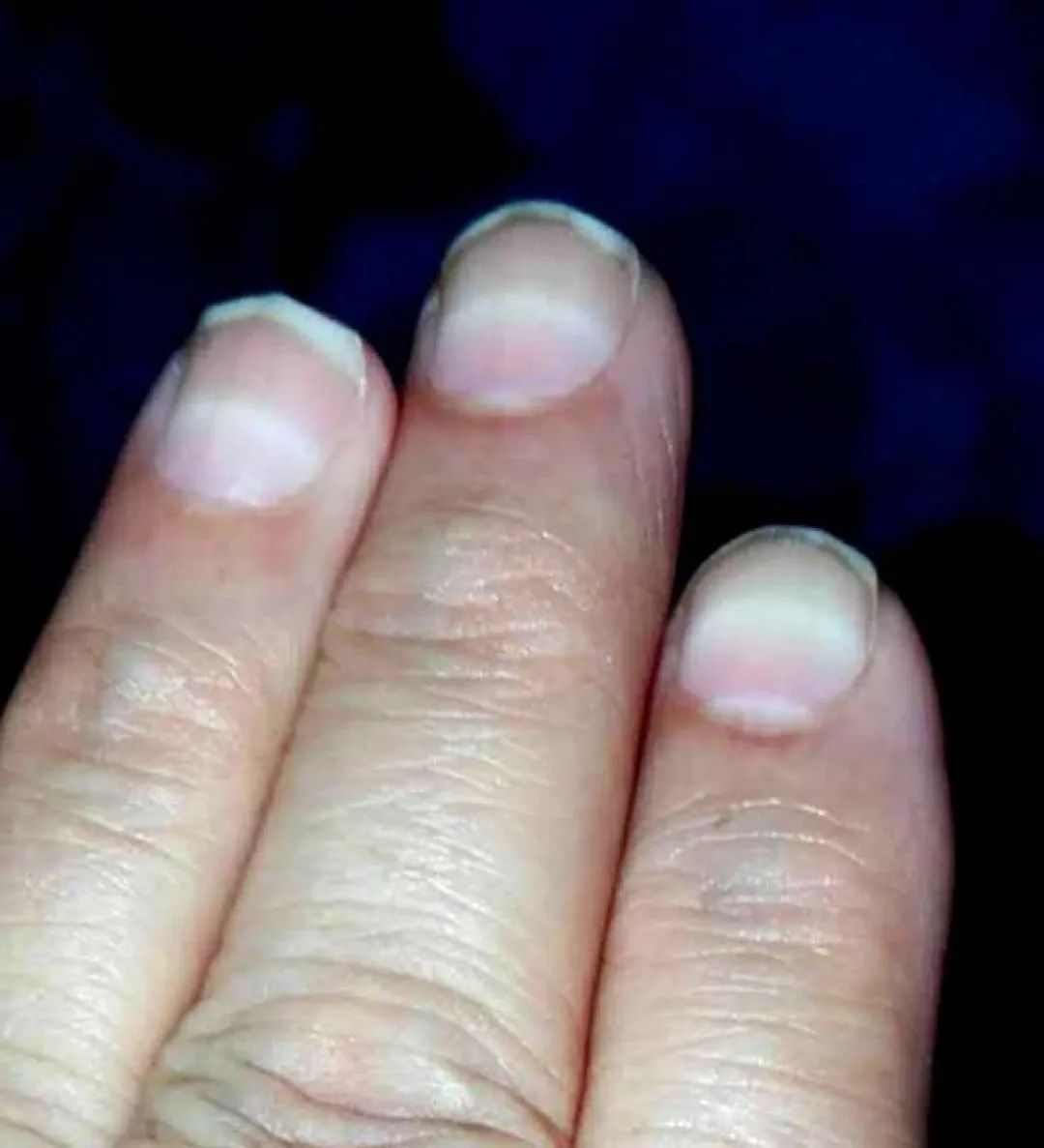 比砒霜还毒！湖南一3岁女童查出急性铊中毒，眼神呆滞、大把脱发、走路如踩棉花……