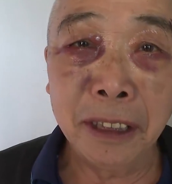 七旬大爷出门散步被拉去割眼袋，销售称“不割以后可能会瞎”，涉事机构回应