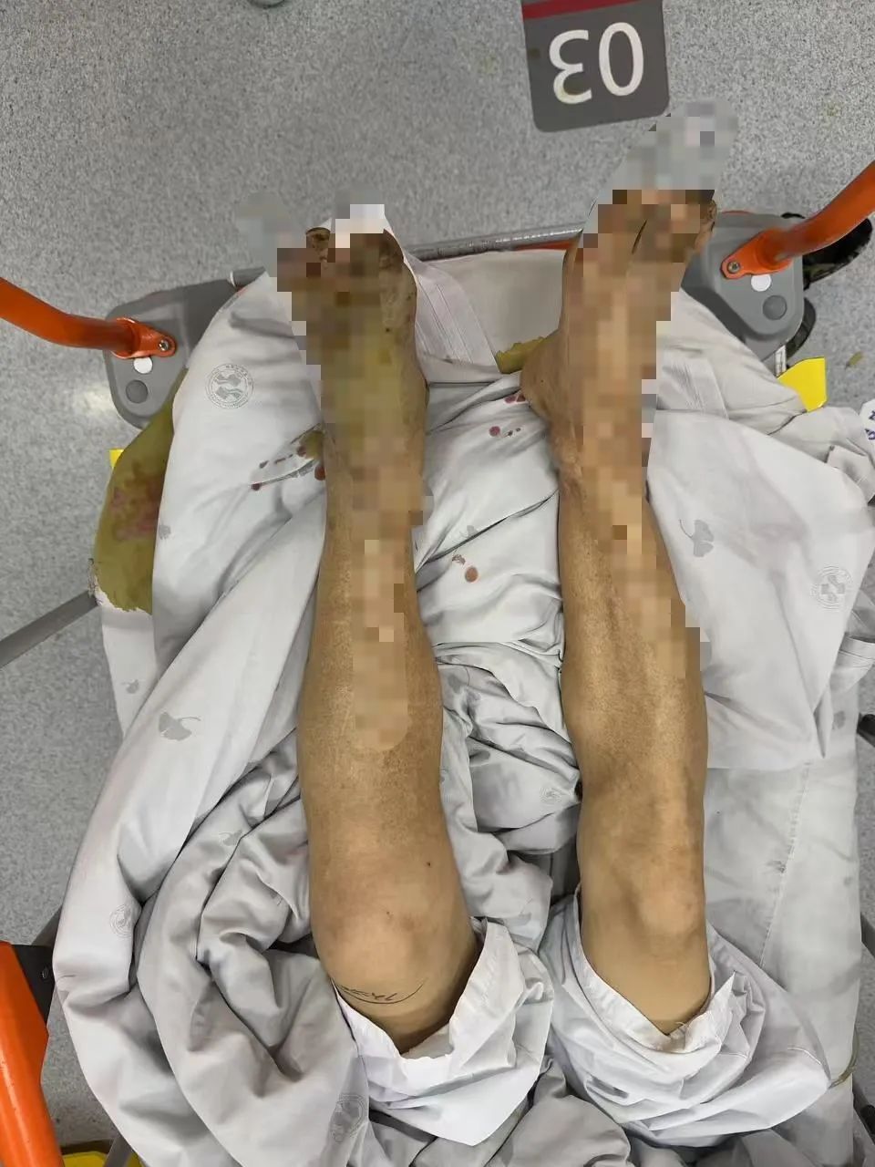 进入高发期！台州一男子被咬一口，肿到青紫！看到请远离