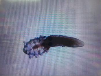 鸡皮疙瘩!女子眼部瘙痒,红肿溃烂!医生发现大量虫子!四类人群高发 鸡皮疙瘩!女子眼部瘙痒,红肿溃烂!医生发现大量虫子!四类人群高发