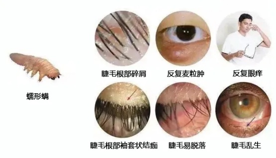 鸡皮疙瘩!女子眼部瘙痒,红肿溃烂!医生发现大量虫子!四类人群高发 鸡皮疙瘩!女子眼部瘙痒,红肿溃烂!医生发现大量虫子!四类人群高发