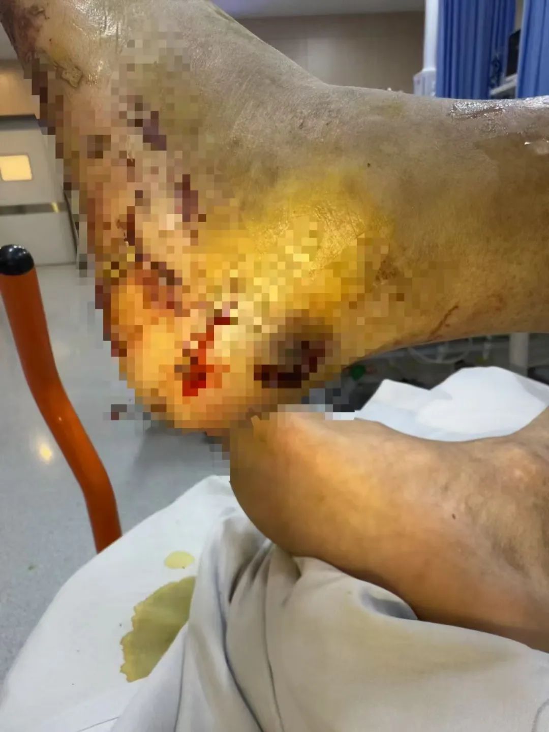 进入高发期！台州一男子被咬一口，肿到青紫！看到请远离