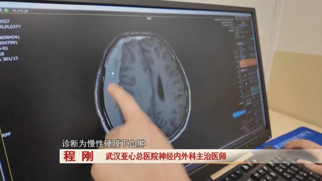 坐了两次过山车,男子突发颅内出血...医生提醒! 坐了两次过山车,男子突发颅内出血...医生提醒!