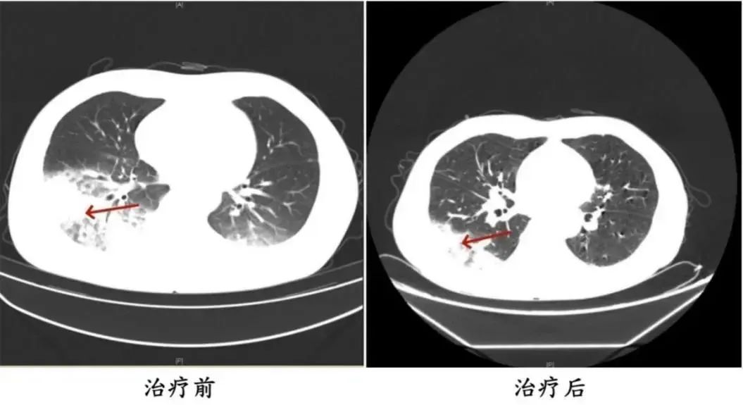 吹了3天空调，男子左肺“白”了一半！高温来袭，紧急提醒→