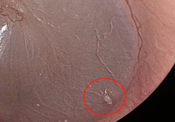 长期跟猫一起睡,男子耳内取出活体 长期跟猫一起睡,男子耳内取出活体