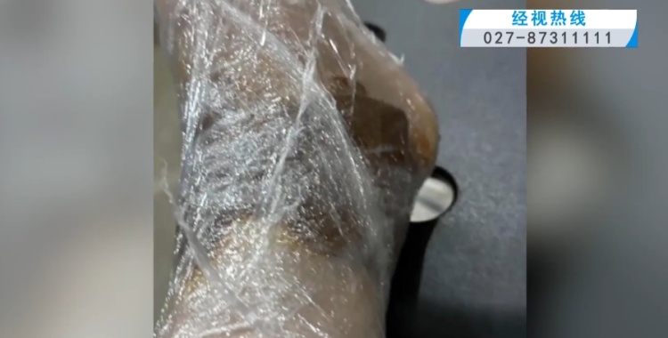 用草木灰消毒止血？ 女子听信偏方险截肢！医生紧急提醒