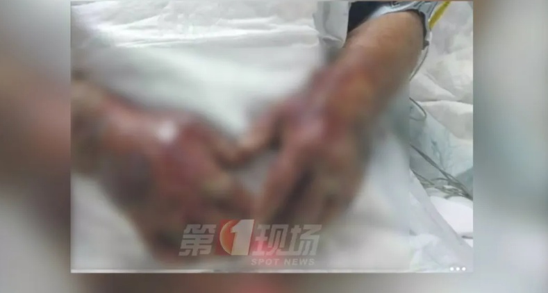 戴手套！戴手套！严重可致死