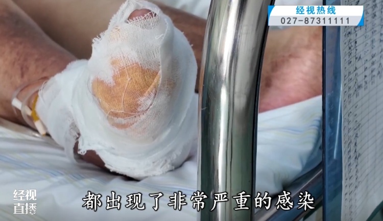 用草木灰消毒止血？ 女子听信偏方险截肢！医生紧急提醒