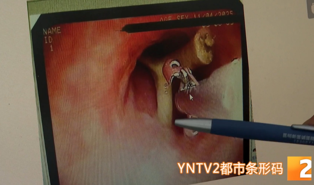 命悬一线！3厘米长鸡骨卡喉，他们上演生命救援