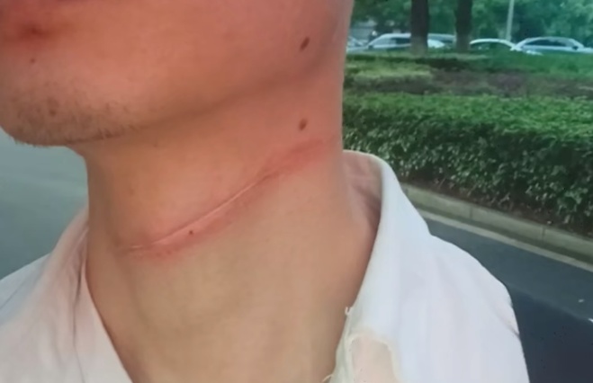 男子骑车遭“割喉”!近期多人遭殃 男子骑车遭“割喉”!近期多人遭殃