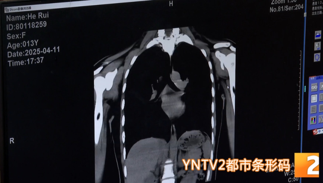 命悬一线！3厘米长鸡骨卡喉，他们上演生命救援