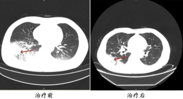 一男子开空调3天“白肺”!重庆直冲33℃,天热了,这个细节要当心…… 一男子开空调3天“白肺”!重庆直冲33℃,天热了,这个细节要当心……
