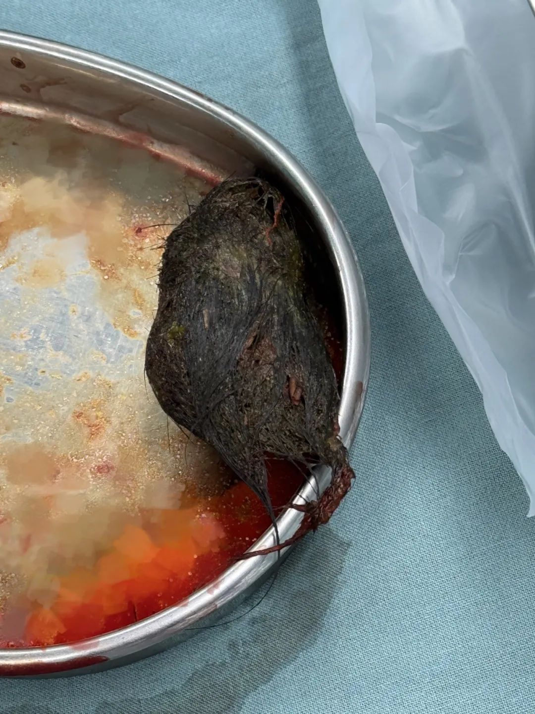 10岁女孩确诊,多地已有病例!有人因羞耻感延误就医 10岁女孩确诊,多地已有病例!有人因羞耻感延误就医