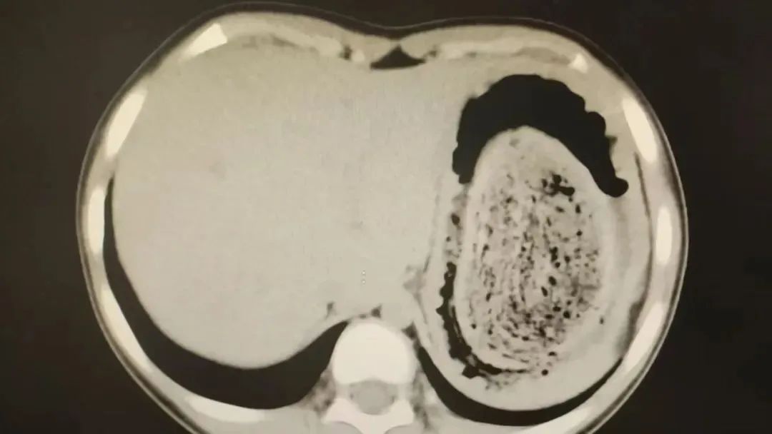 10岁女孩体内这一幕惊呆！有人因羞耻感延误就医，必须重视！