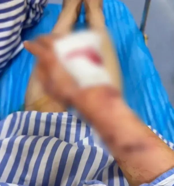 男子被卡数天，女子手筋断裂！警惕家中这些地方→