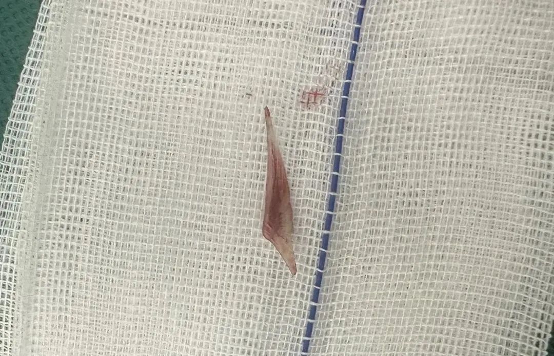 29岁男子鱼刺卡喉后，喝醋、咽米饭…不幸身亡！