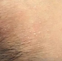 你被汗疱疹、痱子和脚气毒打过吗？华西专家支招