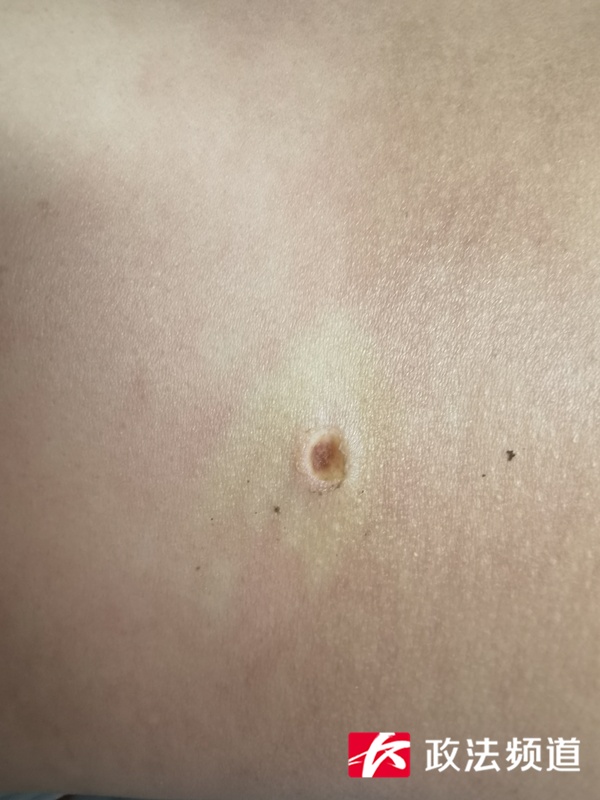 进入活跃期！身上出现这种“黑点”别大意