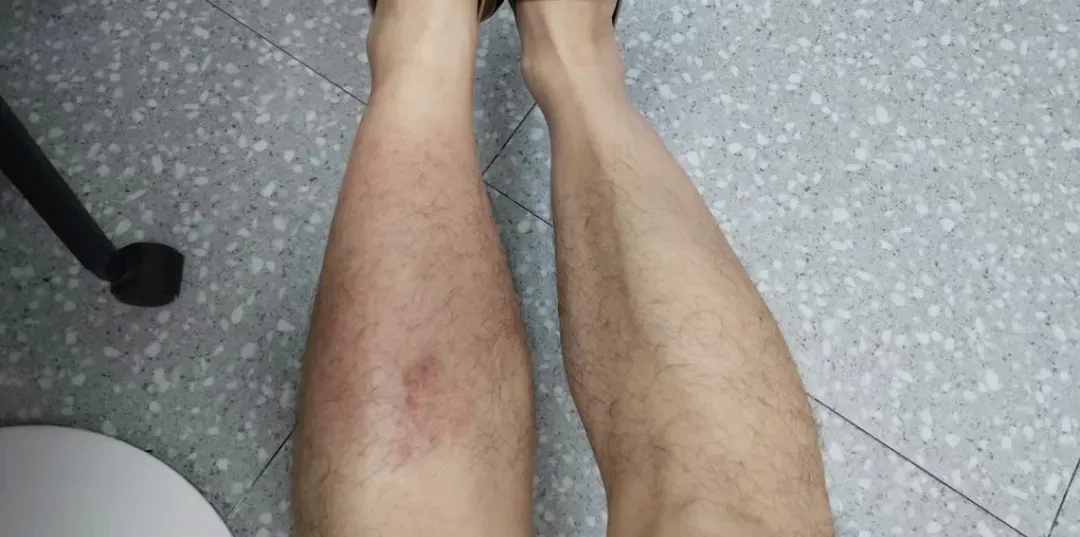 雨天蹚了一回水,烧到40℃,男子竟染上这种病,直接住院了! 雨天蹚了一回水,烧到40℃,男子竟染上这种病,直接住院了!