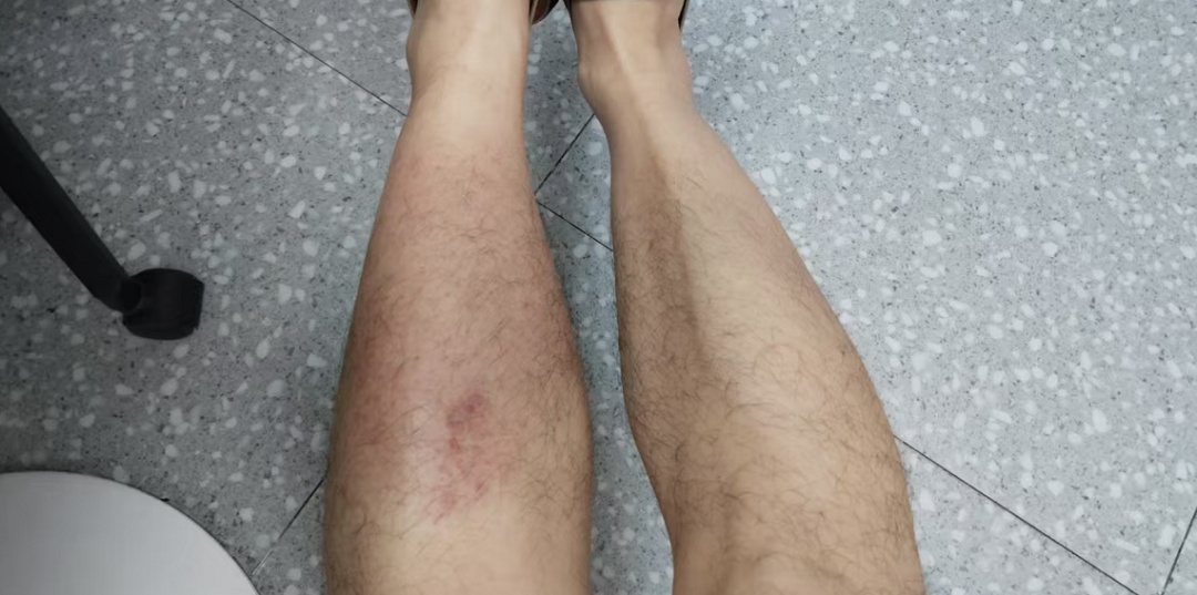 暴雨天蹚水后烧到40℃还染上丹毒!医生紧急提醒! 暴雨天蹚水后烧到40℃还染上丹毒!医生紧急提醒!