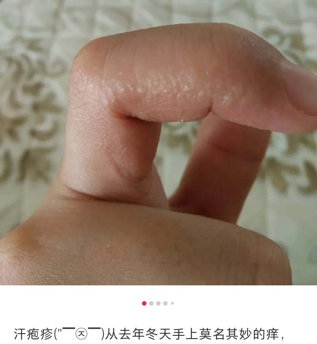 你被汗疱疹、痱子和脚气毒打过吗？华西专家支招