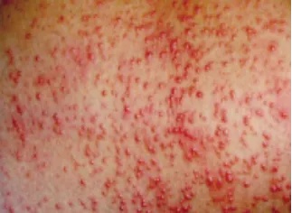 你被汗疱疹、痱子和脚气毒打过吗？华西专家支招