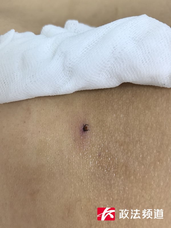 进入活跃期！身上出现这种“黑点”别大意