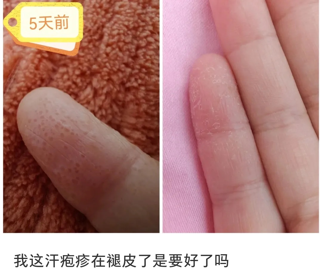 你被汗疱疹、痱子和脚气毒打过吗？华西专家支招