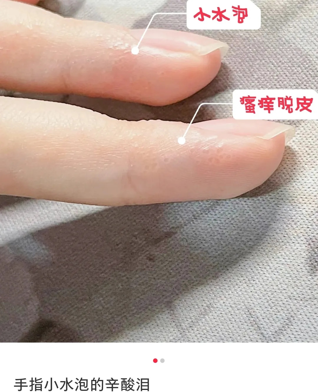 你被汗疱疹、痱子和脚气毒打过吗？华西专家支招