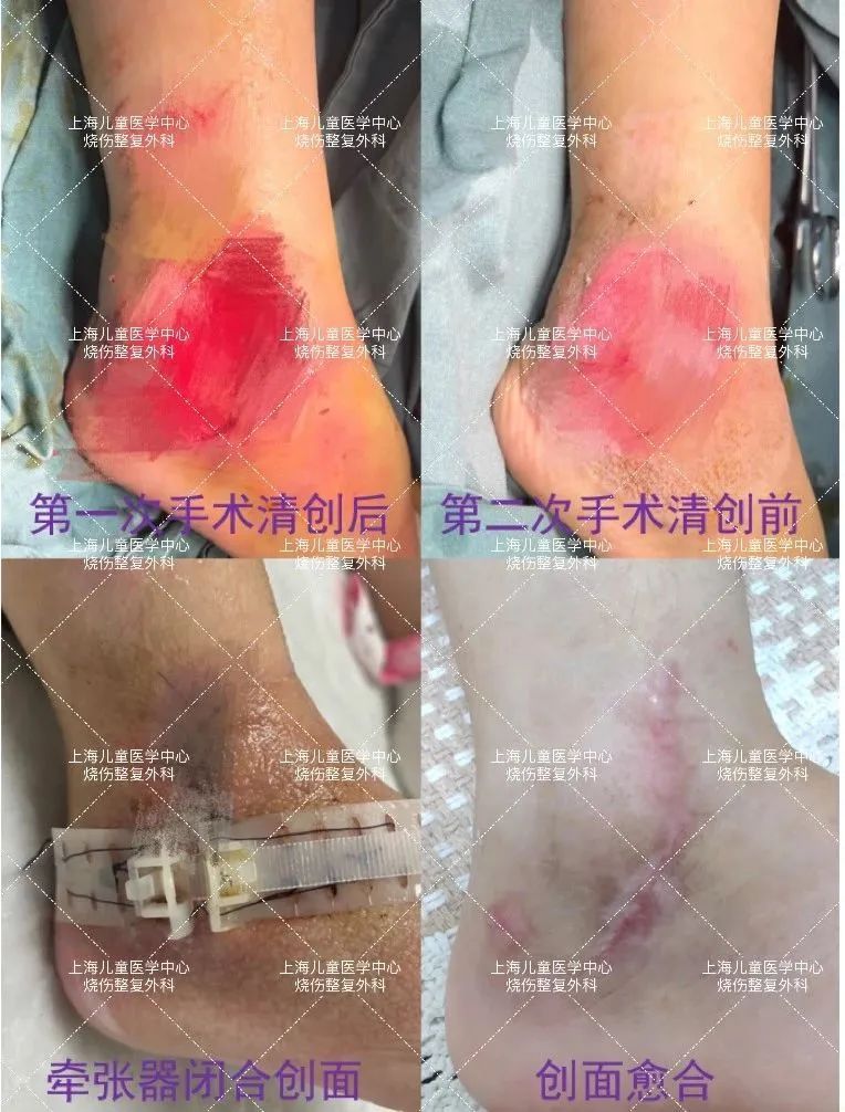 6岁女孩发生意外，父母3天后发现不对劲！这个户外活动很多上海人都爱