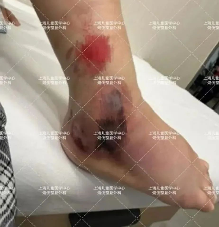 6岁女孩发生意外，父母3天后发现不对劲！这个户外活动很多上海人都爱