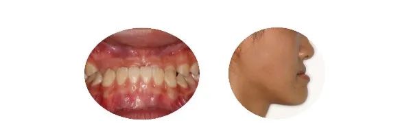 矫正牙齿越早越好吗?放下焦虑,科学正畸! 矫正牙齿越早越好吗?放下焦虑,科学正畸!