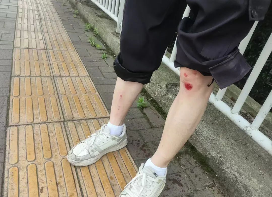 “人差点没了,已报警!”男子骑行中遭风筝线勒喉,如何维权?律师提醒 “人差点没了,已报警!”男子骑行中遭风筝线勒喉,如何维权?律师提醒