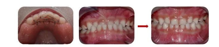 矫正牙齿越早越好吗?放下焦虑,科学正畸! 矫正牙齿越早越好吗?放下焦虑,科学正畸!