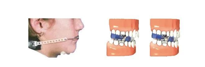 矫正牙齿越早越好吗?放下焦虑,科学正畸! 矫正牙齿越早越好吗?放下焦虑,科学正畸!
