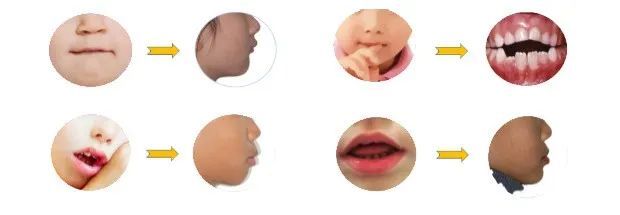 矫正牙齿越早越好吗?放下焦虑,科学正畸! 矫正牙齿越早越好吗?放下焦虑,科学正畸!