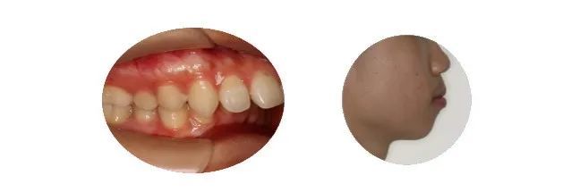 矫正牙齿越早越好吗?放下焦虑,科学正畸! 矫正牙齿越早越好吗?放下焦虑,科学正畸!