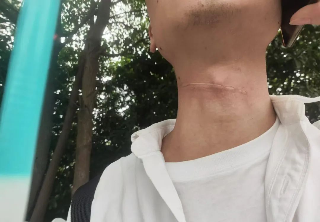 “人差点没了,已报警!”男子骑行中遭风筝线勒喉,如何维权?律师提醒 “人差点没了,已报警!”男子骑行中遭风筝线勒喉,如何维权?律师提醒