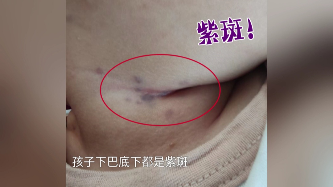 87天男婴身上突长紫斑,确诊急性髓系白血病!医生:可能和这些因素有关 87天男婴身上突长紫斑,确诊急性髓系白血病!医生:可能和这些因素有关