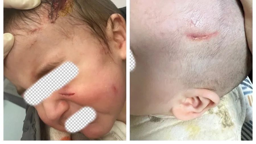 沪上1岁混血萌娃突遭宠物狗扑咬！头面部多处撕裂紧急送医