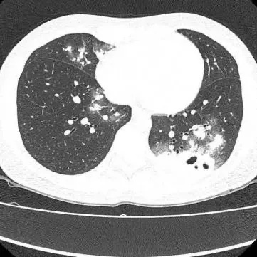 发现1例,阳性!初期或无症状 发现1例,阳性!初期或无症状