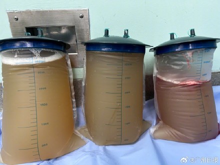 九旬老人腹部胀如西瓜抽出18斤囊液 九旬老人腹部胀如西瓜抽出18斤囊液